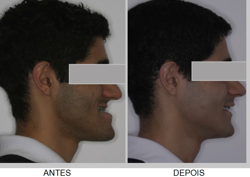 Antes e depois da cirurgia ortognática