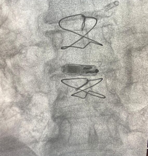 Aparelho já implantado